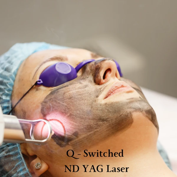 Q - Switched Nd Yag Laser